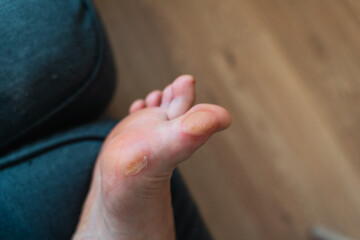 Close-up of a soft callus on a foot of a woman, sport shoes problem, corn on the leg. blister on...