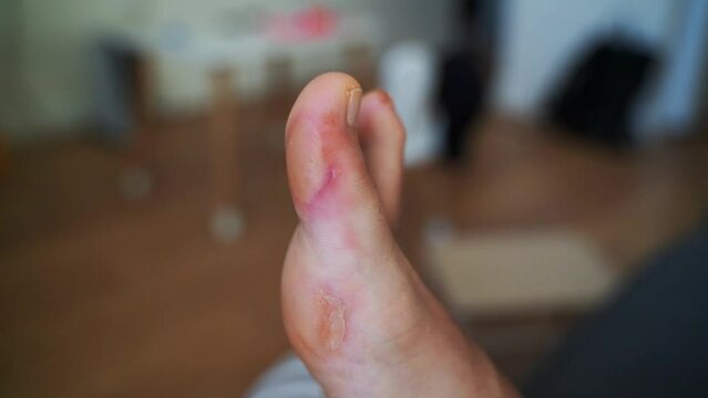 Close-up of a soft callus on a foot of a woman, sport shoes problem, corn on the leg. blister on the feet 