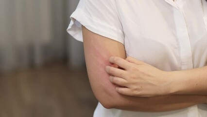 young Caucasian woman suffering from red rash and itching on her arm caused by an allergy, leading to the need to scratch the skin. This emphasizes the importance of skin health care and