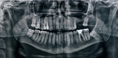 X-ray of the oral cavity with teeth. Orthopantomogram. Panoramic dental tooth X-ray. Toned.