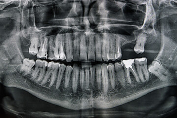X-ray of the oral cavity with teeth. Orthopantomogram.