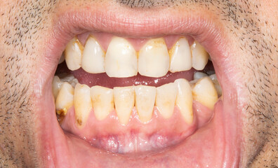 Fototapeta premium Close-up front view examination of a man mouth open with yellowish teeth colored spots because of smoking and bad hygiene, resin composite restorations. Beard hair and lower lip retracted. 