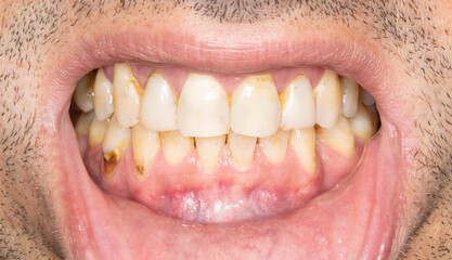 Fototapeta premium Close-up front view examination of a man mouth open with yellowish biting teeth colored spots because of smoking and bad hygiene, resin composite restorations. Beard hair and lower lip retracted. 