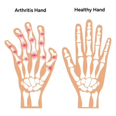 Rheumatoid arthritis and healthy human hands