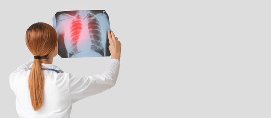 Female doctor holding x-ray image of lungs on light background with space for text