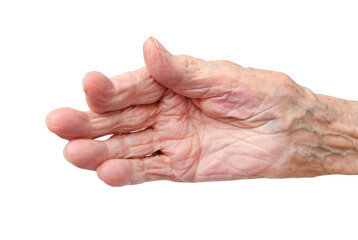 Rheumatoid polyarthritis of the hand of a 95 year old woman isolated on a white background.