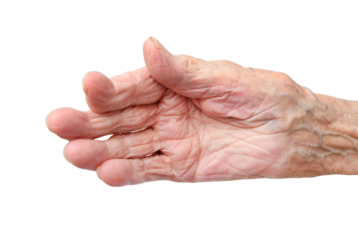 Rheumatoid polyarthritis of the hand of a 95 year old woman isolated on a white background.