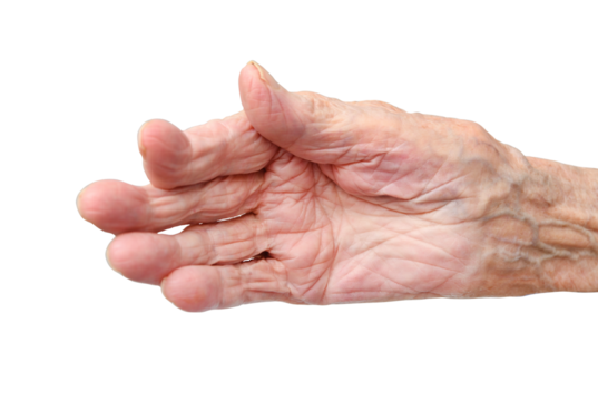 Rheumatoid polyarthritis of the hand of a 95 year old woman isolated on a white background.