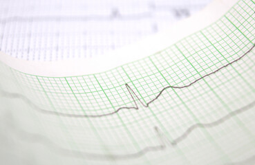 ecg graph