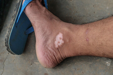 the feet of a young Asian man who experiences itching in the leg area and leaves long scars