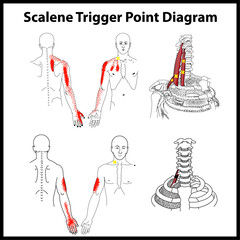 Scalene Trigger Point vector Diagram