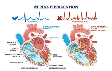 Atrial fibrillation as abnormal heart beat frequency disease outline diagram, transparent background. Labeled educational scheme with cardiovascular condition and heart structure illustration.