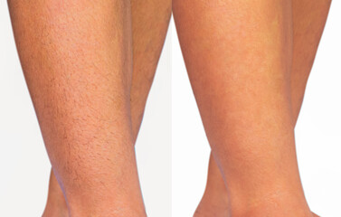 Image compare woman legs with hairs and hairless. Result before and after leg hairs removal, skin care and beauty concept. - obrazy, fototapety, plakaty
