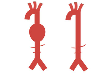 abdominal aortic aneurysm,heart aorta attack, aortic arch bulge open,vein clots stent stroke Marfan root left graft, hernia vessel pain High blood kidney damage Turner,red,pink,purple