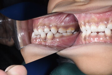 Dentistry clinical case of a biting child with class III orthodontic malocclusion, side view of...