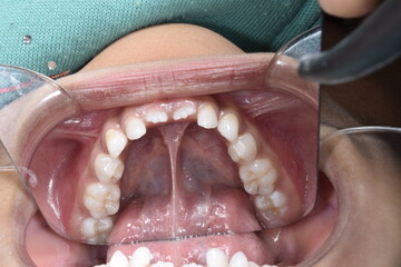 Lower mandibular arch occlusal indirect mirror view of a child dentition. Healthy gingival gum, tongue lifted with voluminous lingual frenum, cheek and lip retracted ,teeth aligned and no decay. - obrazy, fototapety, plakaty