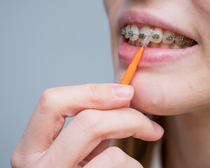 Unrecognizable Caucasian woman cleans braces with a brush. Close-up of female teeth with brackets