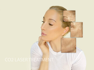 CO2 laser treatment ,Cosmetic Laser Dermatology 
