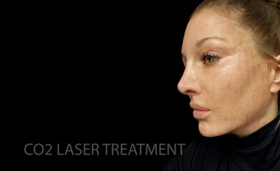 CO2 laser treatment ,Cosmetic Laser Dermatology 