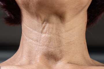 Neck  wrinkles and lines of senior woman. Facial and Neck Skin Aging Change on senior woman.