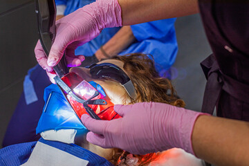 dental photopolymer lamp for fixing fillings during dental treatment with protective glasses