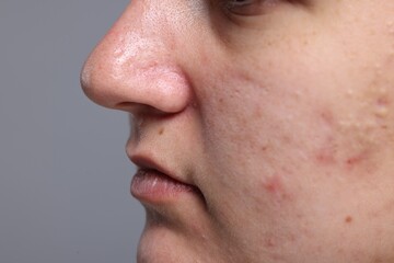 Closeup view of woman with unhealthy skin on grey background