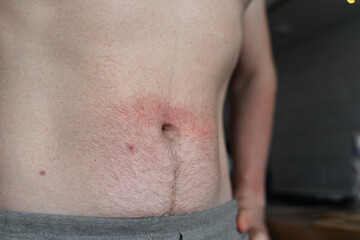 Close-up of man's body belly at home in kitchen with dermatitis rush and red irritation on the skin.
