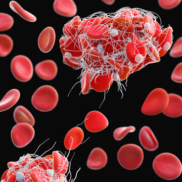 Blood clot, illustration