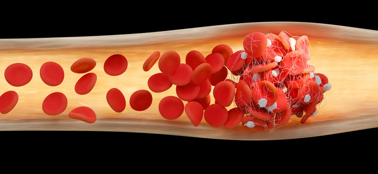 Blood clot, illustration