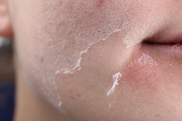Woman with dry skin on face, closeup