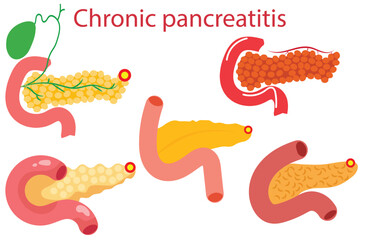 chronic pancreatitis,Pancreas disease logo, chronic pancreatitis. Medical appointment, examination and treatment in clinic. Pain and inflammation in human internal organs. Anatomical examination ,five