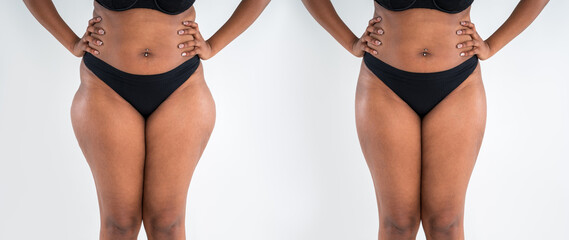 Tummy tuck, fat body before and after weight loss and liposuction on gray background, black African...