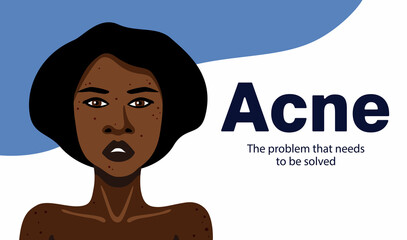 Acne banner with young African American woman minimalistic illustration