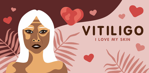 Banner about vitilingo skin disease with elderly Asian woman, minimalistic vector