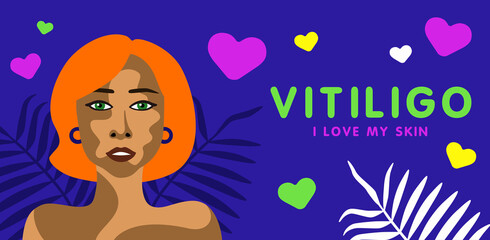 Banner about vitilingo skin disease with young beautiful redhead woman minimalistic vector