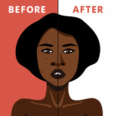 Vector image of African American woman before and after acne skin treatment