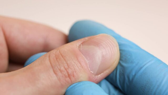 Doctor in gloves examining a ridged fingernails with vertical and horizontal ridges. Nails problems.
