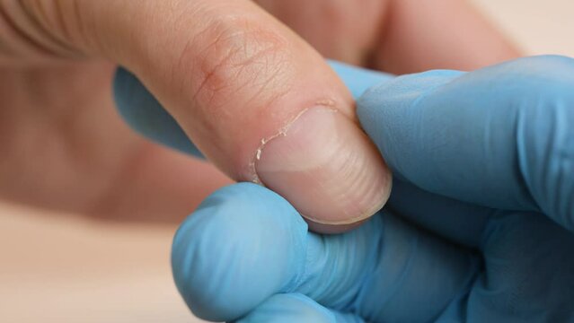 Ingrowing Toe Nails Treatment In Hyderabad | PrettyU by Prettyu Clinic -  Issuu