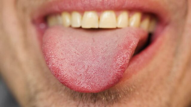 man opens her mouth and shows a tongue and marks and a yellow plaque close-up.