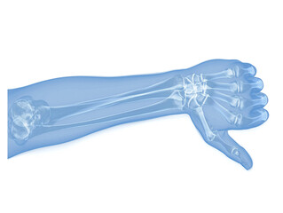 Obraz na płótnie Canvas Pale light blue x-ray image of a forearm and hand with thumb down and folded fingers, forearm bones radius and ulna as well as carpals, metacarpals and phalanges are visible, radiography photograph