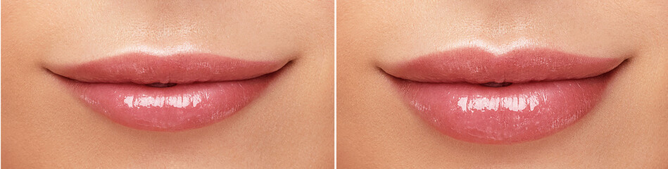Female lips correction before and after comparison. Hyaluronic acid injection. Beauty lip treatment...