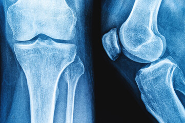 x-ray image of knee AP view for detect Osteoarthritis Knee - obrazy, fototapety, plakaty