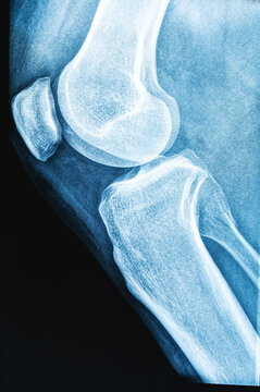 x-ray image of knee AP view for detect Osteoarthritis Knee