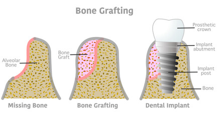 Bone grafting implant steps anatomy, teeth structure. Dental, tooth diagram. Bone titanium screw post, prosthetic crown, abutment, gum. Medical, periodontal. Vector illustration - obrazy, fototapety, plakaty