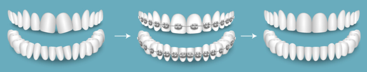 Dental braces before and after result vector illustration