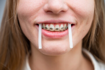 Naklejka premium Close-up portrait of a woman with braces using special orthodontic wax. Girl fooling around pretending to be a walrus.