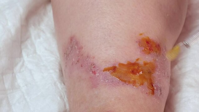 doctor, nurse heals with medicine wounds, venous ulcers on female leg, diabetes mellitus, varicose veins, healing ulcers, eliminating inflammatory process, sanitation pathogenic microflora