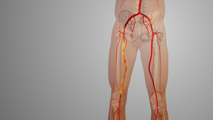 Peripheral artery bypass surgery medical animation - obrazy, fototapety, plakaty