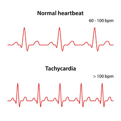Diagram of normal rhythm and Tachycardia for a human heart. Heart cardiogram. Vector illustration in flat style isolated on white background