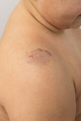 blue bruise on the skin of the arm.